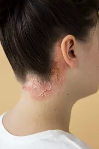 psoriasis en el cuero cabelludo